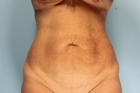 Tummy Tuck: Patient 23 - Before Image 1