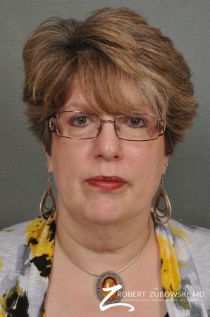 Neck Lift: Patient 7 - Before Image 1