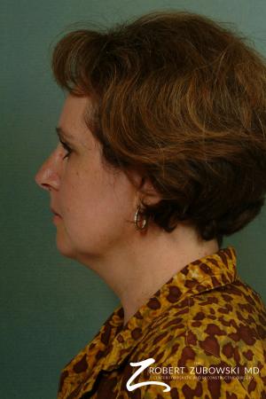 Neck Lift: Patient 8 - Before Image 2