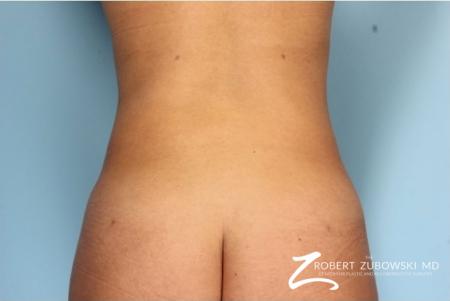 Liposuction: Patient 37 - After Image 1