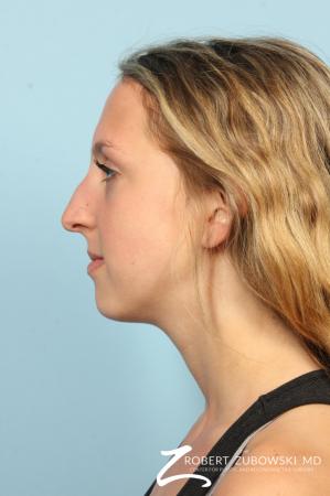 Rhinoplasty: Patient 22 - Before and After Image 2