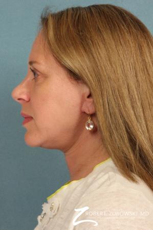 Blepharoplasty: Patient 22 - After Image 2