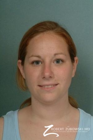 Rhinoplasty: Patient 5 - After Image 1