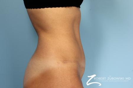 Tummy Tuck: Patient 14 - After Image 2