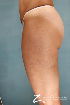 Cellulaze: Patient 1 - After Image 1