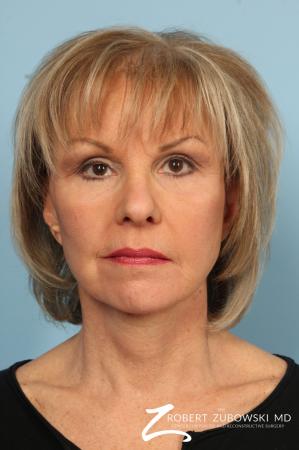 Facelift: Patient 3 - After Image 1