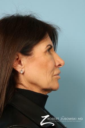 Lip Augmentation: Patient 1 - After Image 2