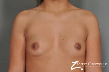 Breast Augmentation: Patient 12 - Before Image 1
