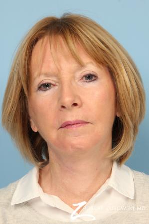 Facelift: Patient 20 - After Image 1