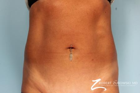 CoolSculpting®: Patient 3 - After Image 1