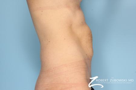 Tummy Tuck: Patient 6 - Before and After Image 2
