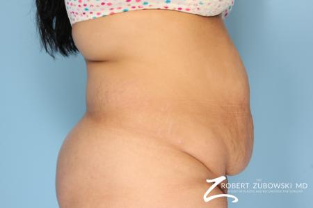 Tummy Tuck: Patient 15 - Before and After Image 2