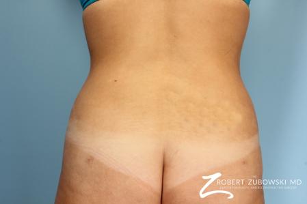 Liposuction: Patient 13 - After Image 1