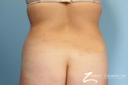 Liposuction: Patient 13 - Before Image 1