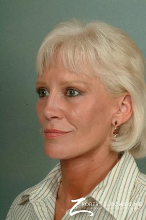 Facelift: Patient 7 - After Image 2