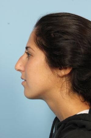 Rhinoplasty: Patient 20 - Before Image 2