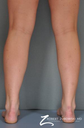 Liposuction: Patient 21 - After Image 1