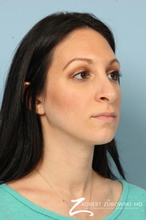 Rhinoplasty: Patient 25 - Before and After Image 3
