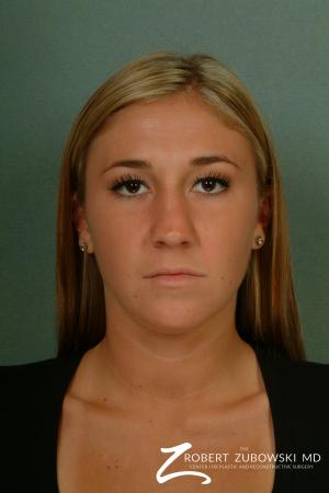 Rhinoplasty: Patient 1 - Before Image 1