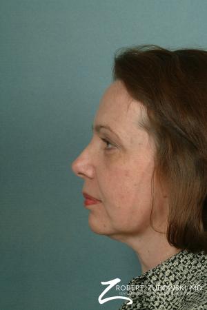 Facelift: Patient 11 - Before and After Image 2