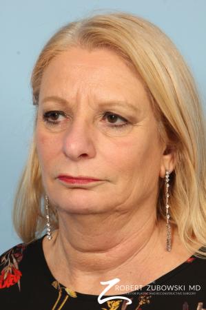 Blepharoplasty: Patient 17 - Before and After Image 2