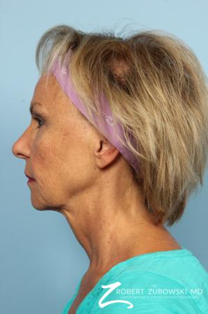 Facelift: Patient 3 - Before and After Image 3