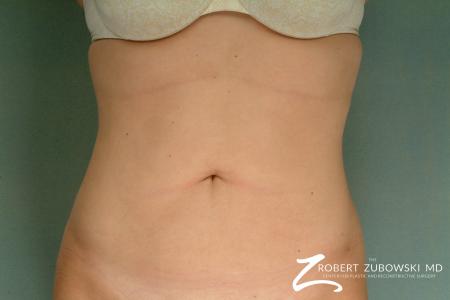 Liposuction: Patient 24 - After Image 1