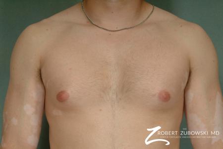 Gynecomastia: Patient 5 - Before Image 1