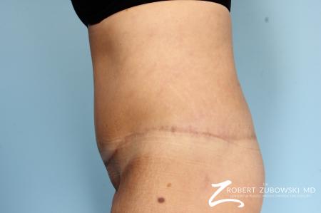 Body Lift: Patient 4 - After Image 2