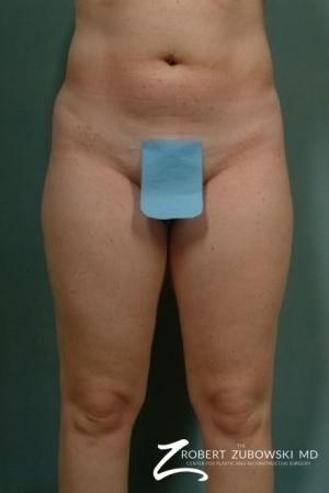 Liposuction: Patient 4 - Before Image 1