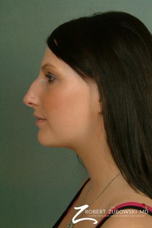 Rhinoplasty: Patient 2 - Before and After Image 2