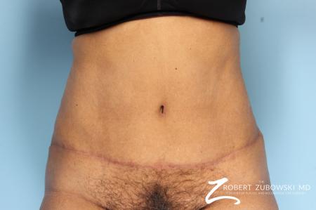 Tummy Tuck: Patient 18 - After Image 1