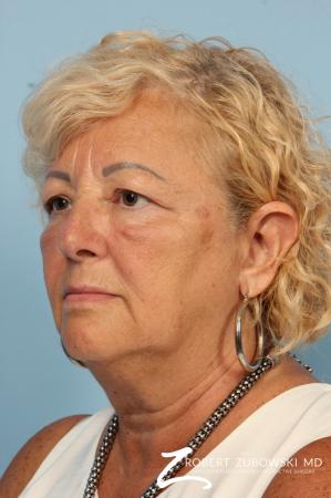 Blepharoplasty: Patient 16 - Before and After Image 2