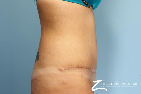 Tummy Tuck: Patient 17 - After Image 2