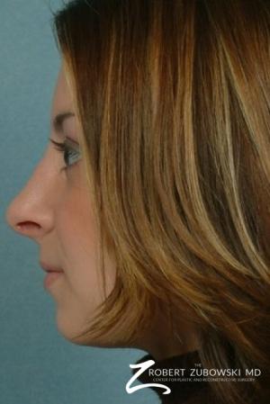 Rhinoplasty: Patient 6 - After Image 2
