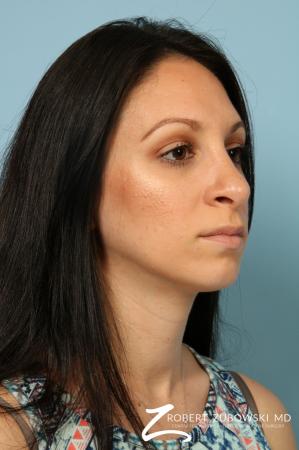 Rhinoplasty: Patient 25 - After Image 3