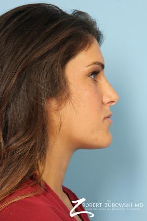 Rhinoplasty: Patient 19 - After Image 2