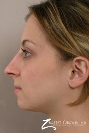 Rhinoplasty: Patient 6 - Before and After Image 2