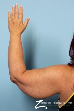Arm Lift: Patient 4 - Before and After Image 2