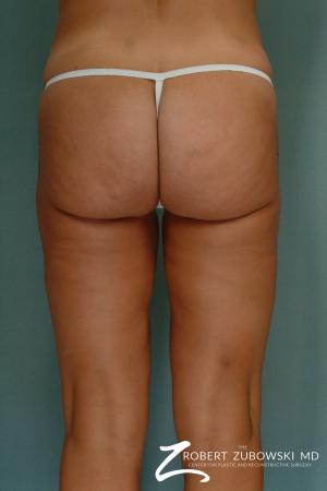 Liposuction: Patient 33 - After Image 4