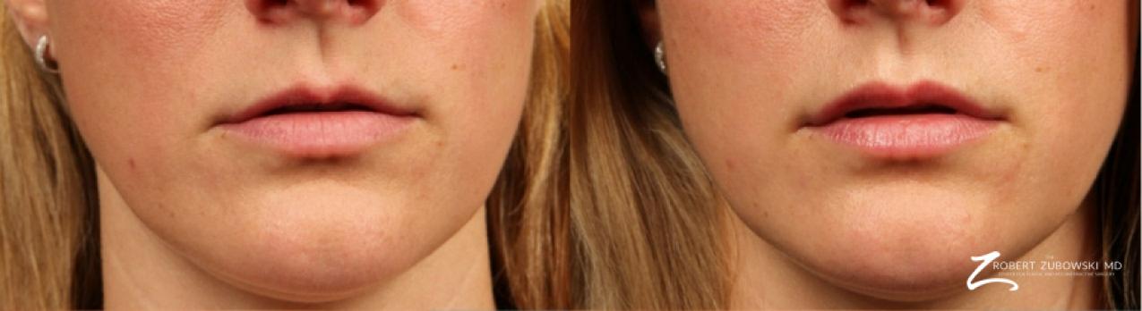 Permanent Lip Enhancement: Patient 1 - Before and After  