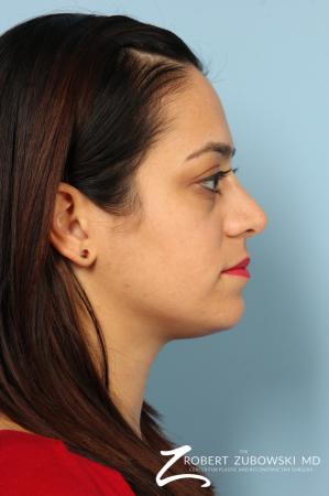 Rhinoplasty: Patient 15 - After Image 2