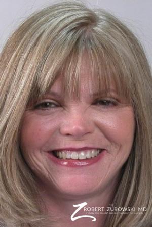 Facelift: Patient 4 - After Image 1