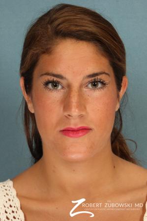 Rhinoplasty: Patient 19 - Before Image 1
