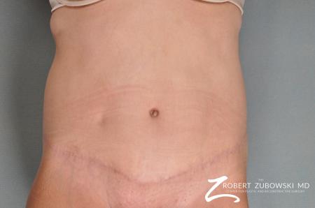 Tummy Tuck: Patient 7 - After Image 1