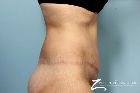 Body Lift: Patient 9 - After Image 2