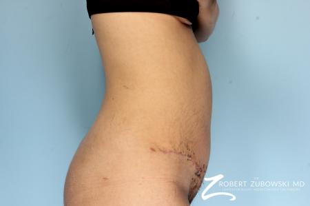Liposuction: Patient 44 - After Image 2