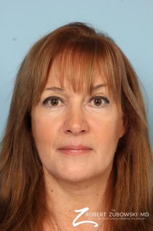 Chemical Peel: Patient 1 - After Image 1