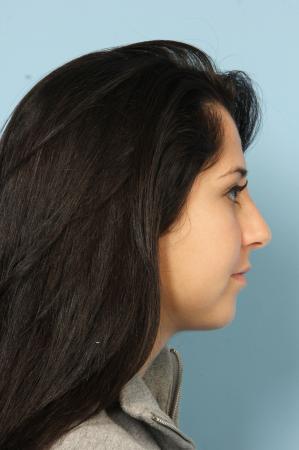 Rhinoplasty: Patient 20 - After Image 3