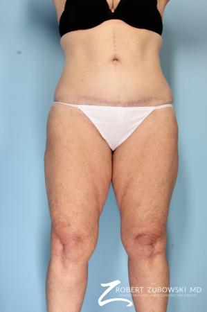 Body Lift: Patient 5 - After Image 1
